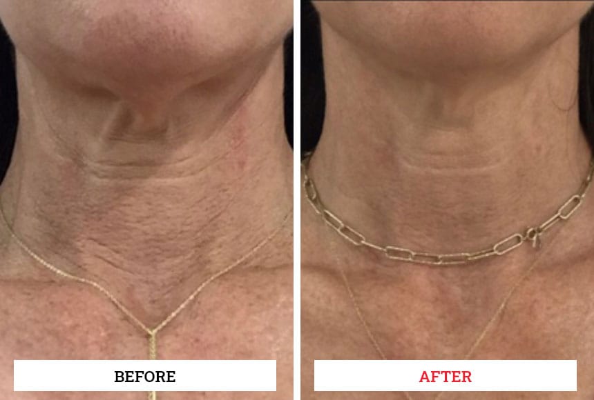 PDO Mono Threads Skinstitute